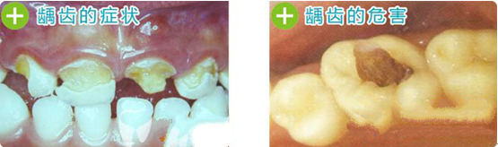 龋齿,蛀牙