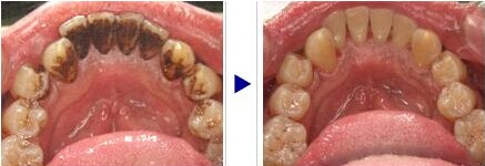 大块牙石振下,而喷砂能把附着在牙齿上的茶垢,烟垢及食物软垢清理干净