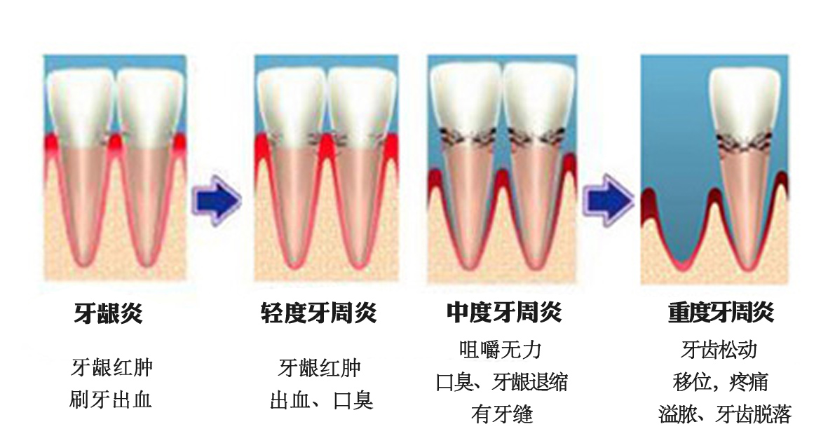 牙周炎不及时治疗有哪些危害？